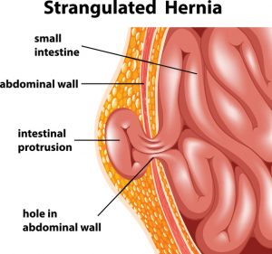 strangulated hernia diagram