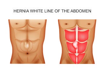 Abdominal hernia illustration