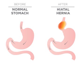 hiatal hernia illustration